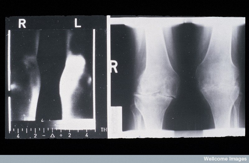 Protecting Knees from Arthritis